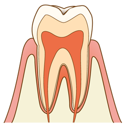 虫歯の進行と治療法c0