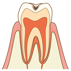 虫歯の進行と治療法c1