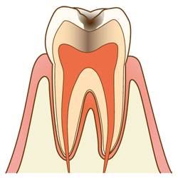虫歯の進行と治療法c2