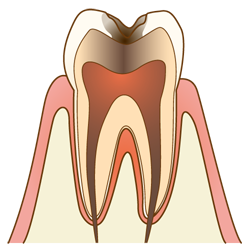 虫歯の進行と治療法c3