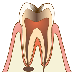 虫歯の進行と治療法c4